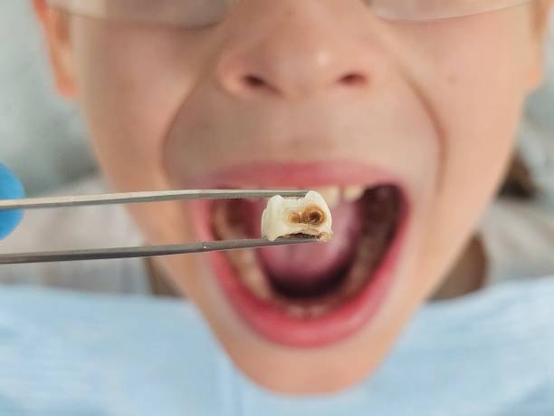 Best Emergency Tooth Extraction in Keansburg, NJ